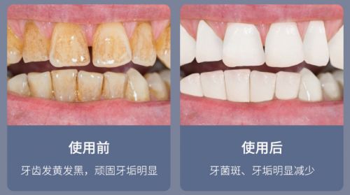 告別刷牙盲區(qū)，現(xiàn)代口腔護(hù)理新選擇 為何它能解決你的深層困擾